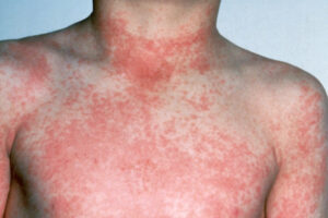 Can Strep Throat Cause Skin Rash Differences Explained Clearly: