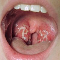 How Long Does a Strep Throat Last Without Antibiotics: Serious Risks Everyone Should Know