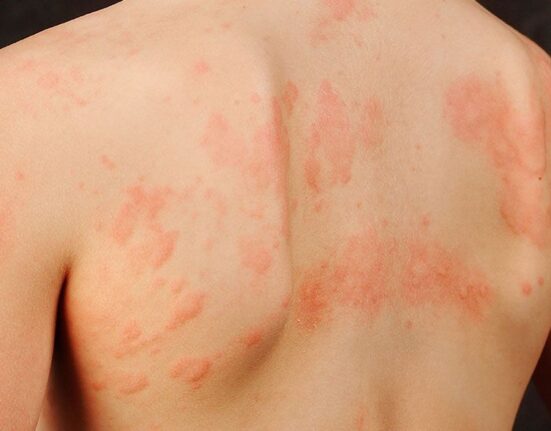 Can Strep Throat Cause Skin Rash - 7 Shocking Data! 
