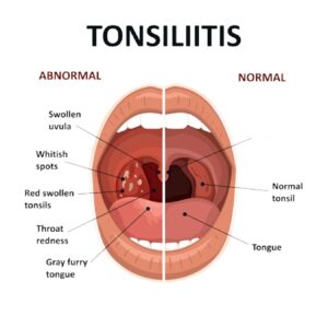 Recognizing Tonsillitis Strep Throat Symptoms Before They Reach Full Peak: