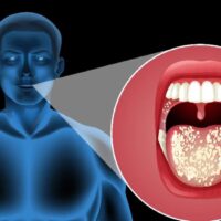 Tonsillitis vs Strep Throat: 10 Critical Differences You Must Know!
