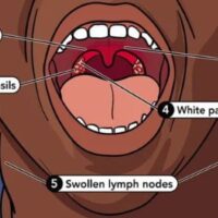 7 Dangerous Untreated Strep Throat Risks You Must Know !
