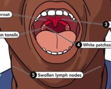7 Dangerous Untreated Strep Throat Risks You Must Know !