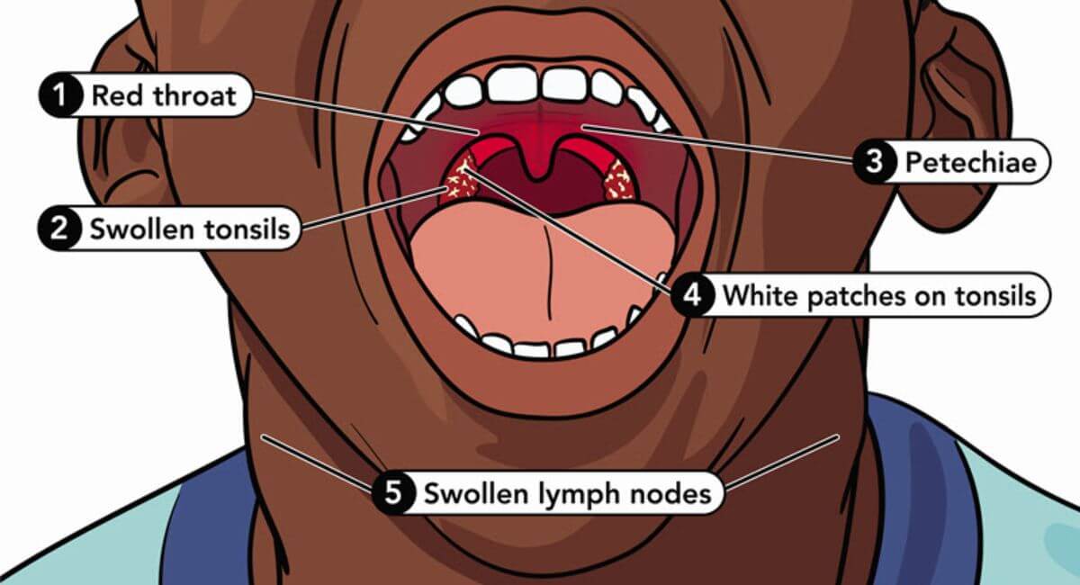 Untreated Strep Throat - 7 Proven Facts That Save Lives!