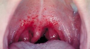 What Actually Makes Strep Throat Spread So fluently:
