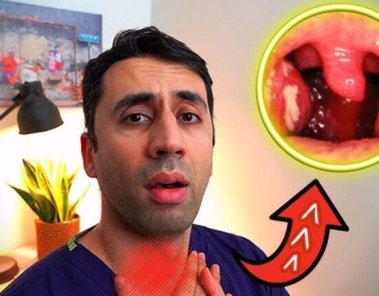 Tonsillitis Strep Throat - 7 Brutal Truths Doctors Never Share!