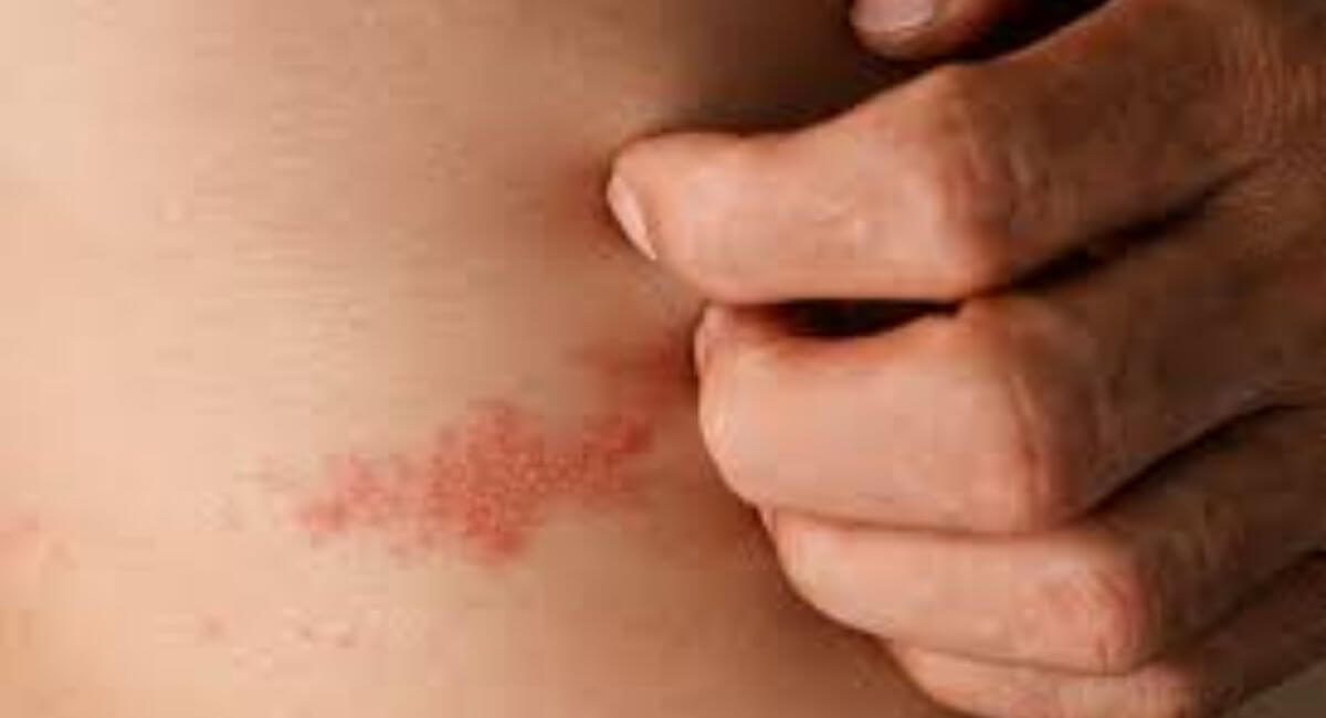 Can Strep Throat Cause Skin Rash - 7 Warning Signs You Should Never Ignore!