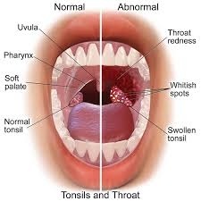 Untreated Strep Throat 10 Dangerous Data You Must Know! 