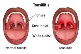 What Tonsillitis Strep Throat Actually Is and Why It Hits So Hard: 