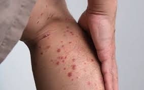 Can Strep Throat Cause Skin Rash Guttate Psoriasis Connection: 