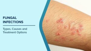 Managing Symptoms Depending On Infection Type: