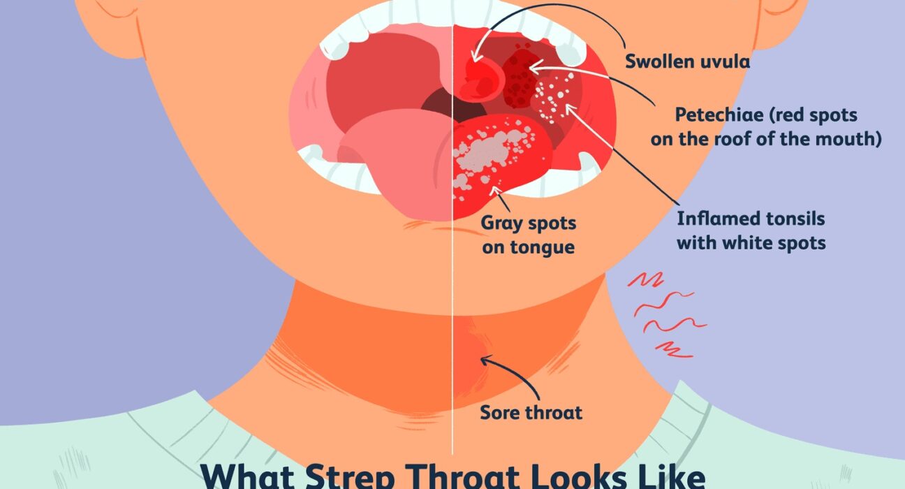 7 Shocking Facts About Does Strep Throat Go Away On Its Own!