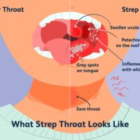 7 Shocking Facts About Does Strep Throat Go Away On Its Own!