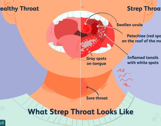 7 Shocking Facts About Does Strep Throat Go Away On Its Own!