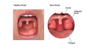 Common miscalculations People Make With Throat Infections: 