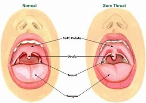 Serious Complications That Can Develop From Untreated Strep Throat: