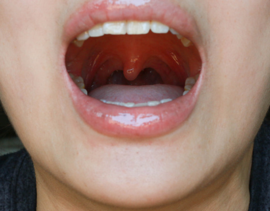 Can Strep Throat Go Away - 7 Important Truths Revealed!