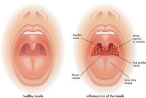 Essential Medical Facts About Tonsillitis Vs Strep Throat: