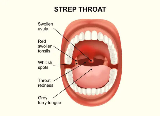 Strep Throat Without Tonsils: 10 Critical Things You Must Know!