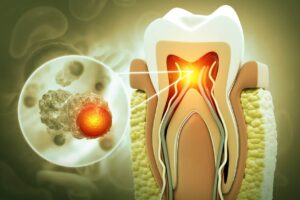 How Delayed Treatment Allows Blood Infection From Tooth Infection to Develop: