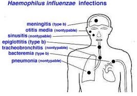 How Haemophilus Flu Symptoms Escalate Without Proper Treatment:
