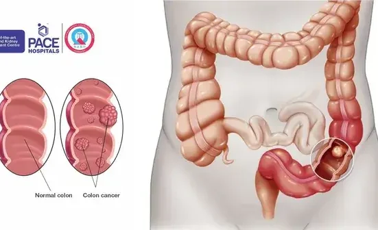 Colon Cancer Awareness Month - 7 Alarming Warnings!