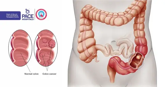 Colon Cancer Awareness Month - 7 Alarming Warnings!