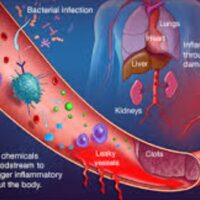 Sepsis in Spanish - 7 Shocking Realities!