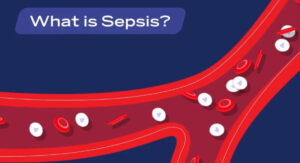 How Sepsis in Spanish Is Actually Diagnosed: