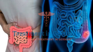 Colon Cancer Stages and Treatment Approaches: