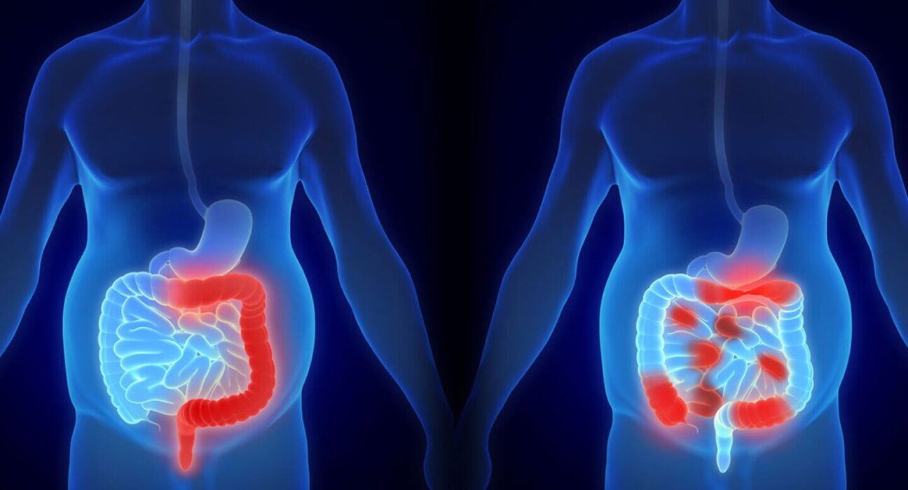 Colon Cancer Surgery - 7 Honest Facts!