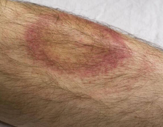 Lyme Disease Symptoms - 7 Warning Signs You Should Never Ignore!