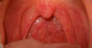 The Real Story Behind Strep Throat Contagious Spread: