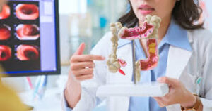 Colon Cancer Stages and the Importance of Early Detection: