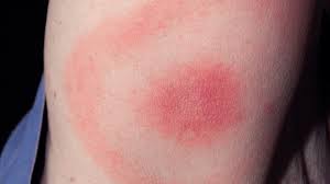 Lyme Disease Symptoms and How Infection Starts: