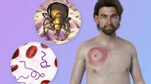 Lyme Disease Symptoms and Blood Testing Reality: