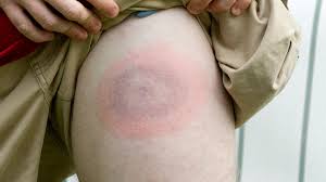 Symptoms of Lyme Disease and the Starting Point: