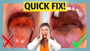 What Strep Throat Treatment Home Actually Addresses?