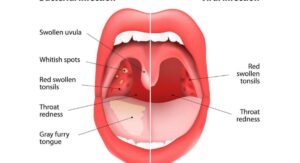 Does Strep Throat Cause Cough and the Short Answer