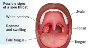Does Strep Throat Cause Cough Versus What It Actually Causes