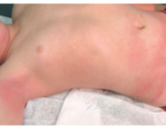 Can Strep Throat Cause a Rash - 7 Brutal Truths Doctors Never Share!