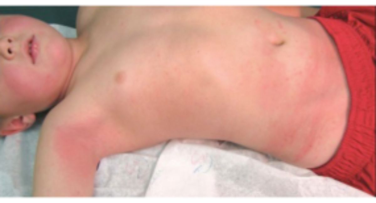 Can Strep Throat Cause a Rash - 7 Brutal Truths Doctors Never Share!