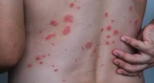 Can Strep Throat Cause a Rash — The Basic Explanation