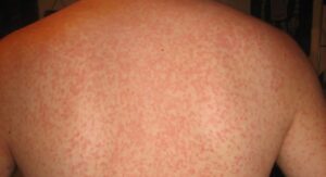Can Strep Throat Cause a Rash Before the Throat Symptoms Are Obvious
