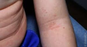 Can Strep Throat Cause a Rash That Gets Worse Without Antibiotics
