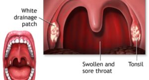 Strep Throat Symptoms in Toddlers Explained Now: