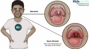 Strep Throat Symptoms Toddlers Versus Common Cold: