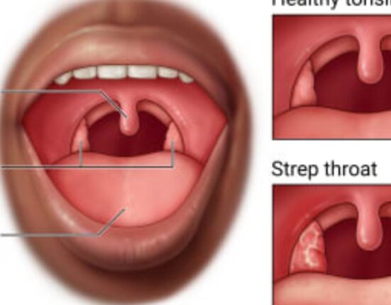 What Causes Strep Throat - 7 Shocking Facts Revealed!
