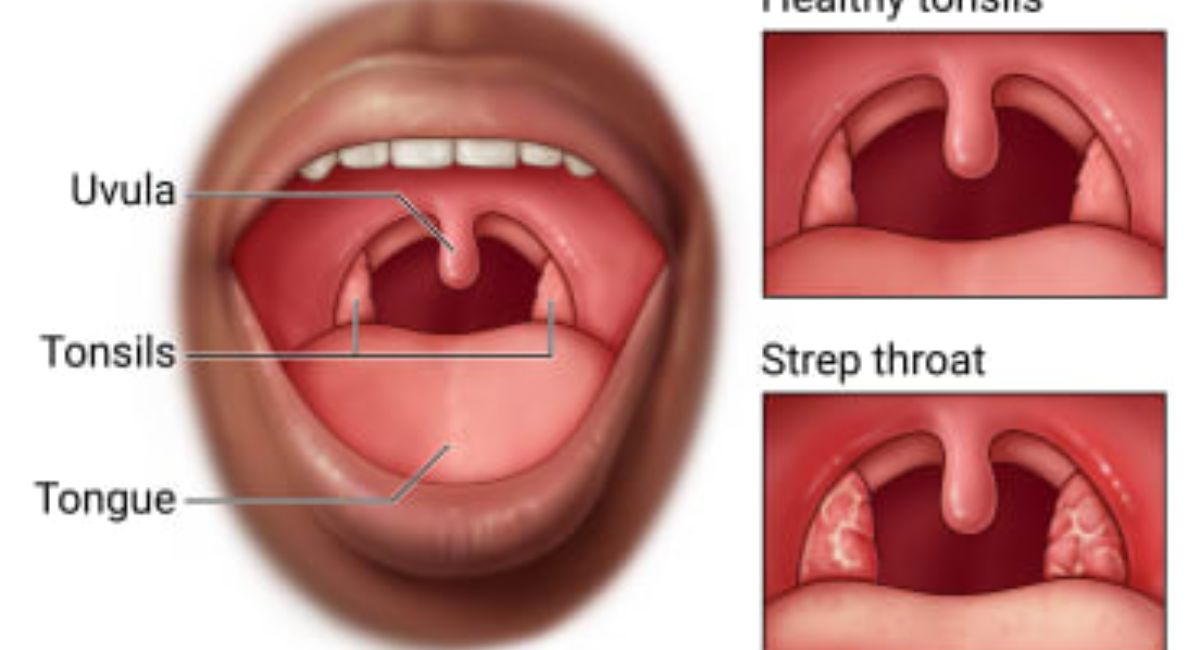 What Causes Strep Throat - 7 Shocking Facts Revealed!