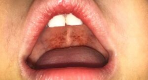 Seasonal Patterns in What Causes Strep Throat Infections
